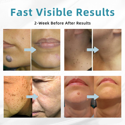 𝐉𝐚𝐬𝐬𝐞𝐞𝐦® Medical-Grade Laser Pen 🔥 (Powered by CO₂ laser technology – effectively removes moles, warts, skin tags, pigmentation marks, and other skin imperfections)🏆