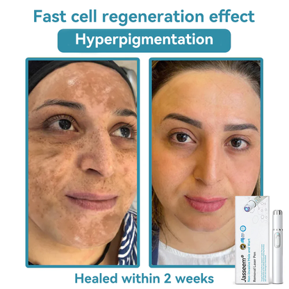 𝐉𝐚𝐬𝐬𝐞𝐞𝐦® Medical-Grade Laser Pen 🚚🎁(Powered by CO₂ laser technology – effectively removes moles, warts, skin tags, pigmentation marks, and other skin imperfections)