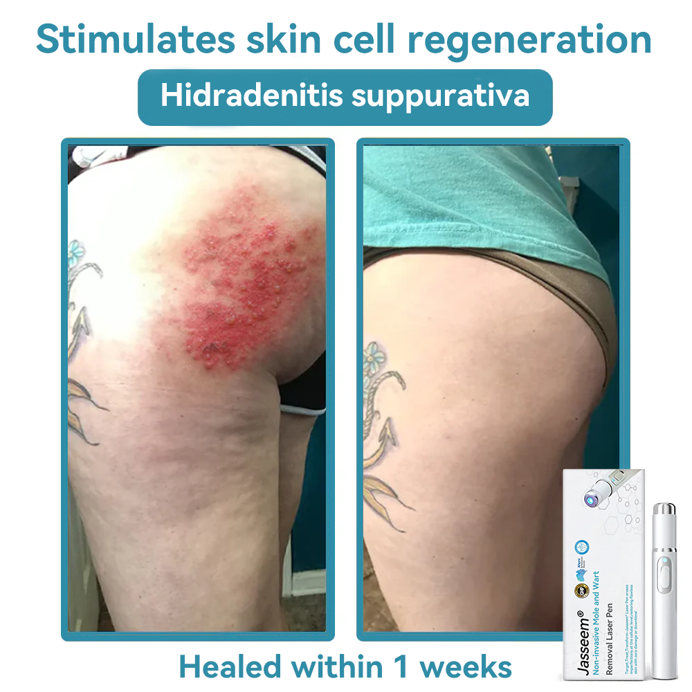 𝐉𝐚𝐬𝐬𝐞𝐞𝐦® Medical-Grade Laser Pen 🚚🎁(Powered by CO₂ laser technology – effectively removes moles, warts, skin tags, pigmentation marks, and other skin imperfections)