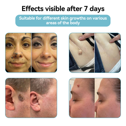 𝐉𝐚𝐬𝐬𝐞𝐞𝐦® Medical-Grade Laser Pen 🚚🎁(Powered by CO₂ laser technology – effectively removes moles, warts, skin tags, pigmentation marks, and other skin imperfections)