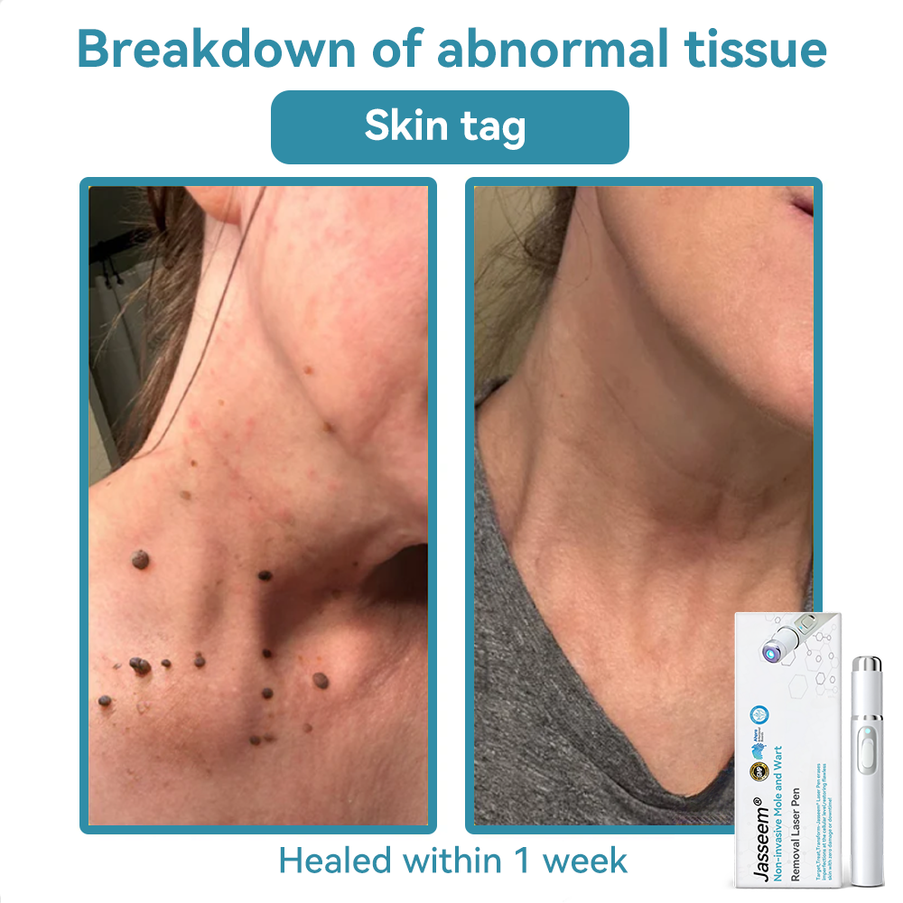 𝐉𝐚𝐬𝐬𝐞𝐞𝐦® Medical-Grade Laser Pen 💕 (Powered by CO₂ laser technology – effectively removes moles, warts, skin tags, pigmentation marks, and other skin imperfections)🏆
