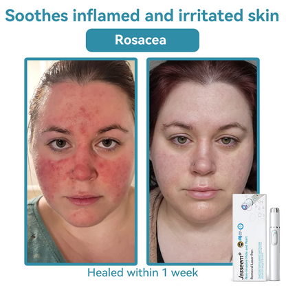𝐉𝐚𝐬𝐬𝐞𝐞𝐦® Medical-Grade Laser Pen 🔥 (Powered by CO₂ laser technology – effectively removes moles, warts, skin tags, pigmentation marks, and other skin imperfections)🏆